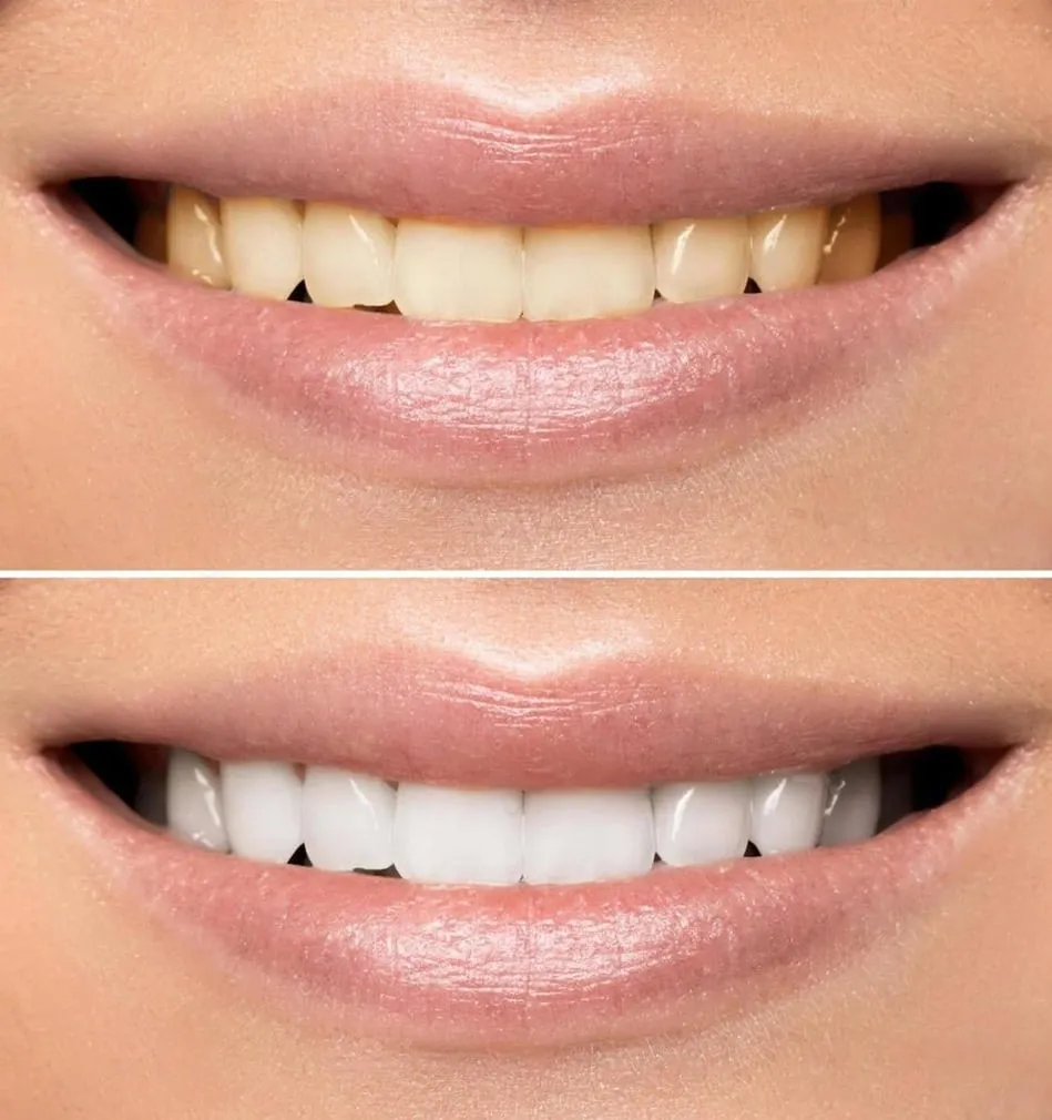 Professional teeth whitening before and after